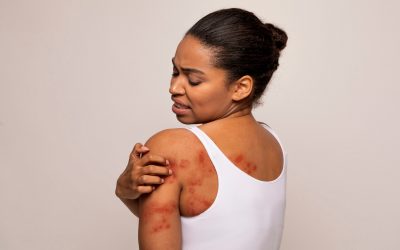 black-woman-scratching-red-spots-on-her-skin-2025-03-18-16-59-46-utc (1) (1)